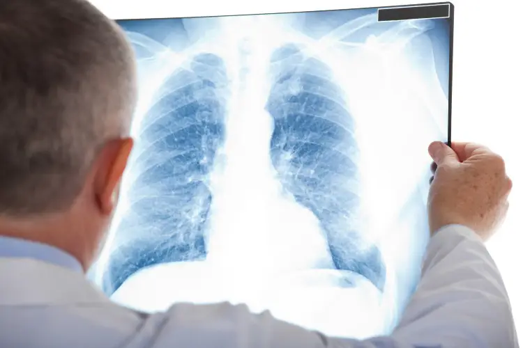 doctor viewing lung x ray of tuberculosis infected patient