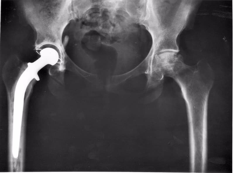 Hip Implant