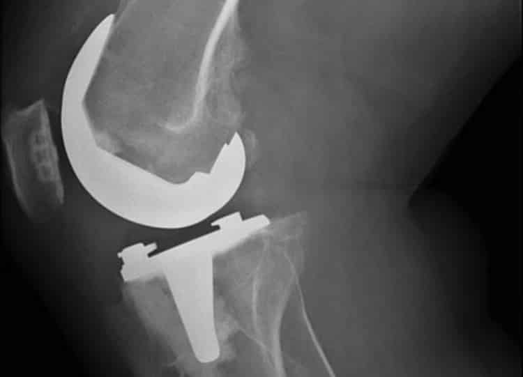 Knee Implant X-Ray