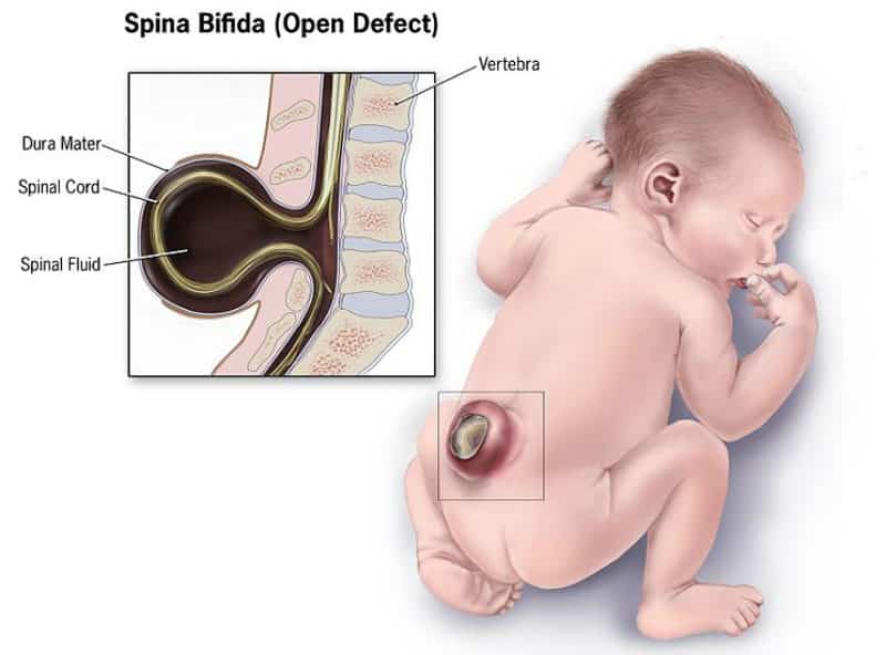 Spina Bifida Graphic