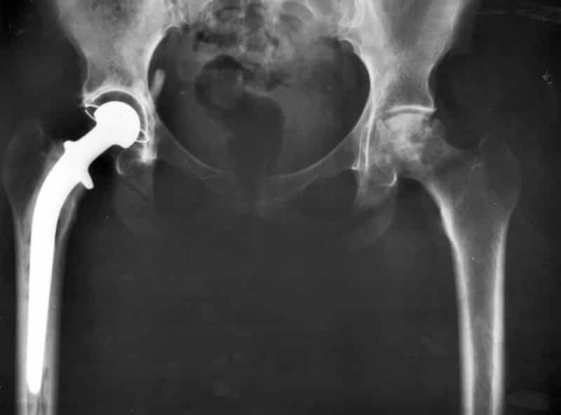 X-Ray of Hip Implant